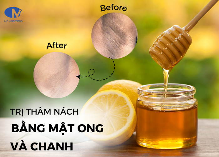 Trị thâm nách bằng mật ong và chanh