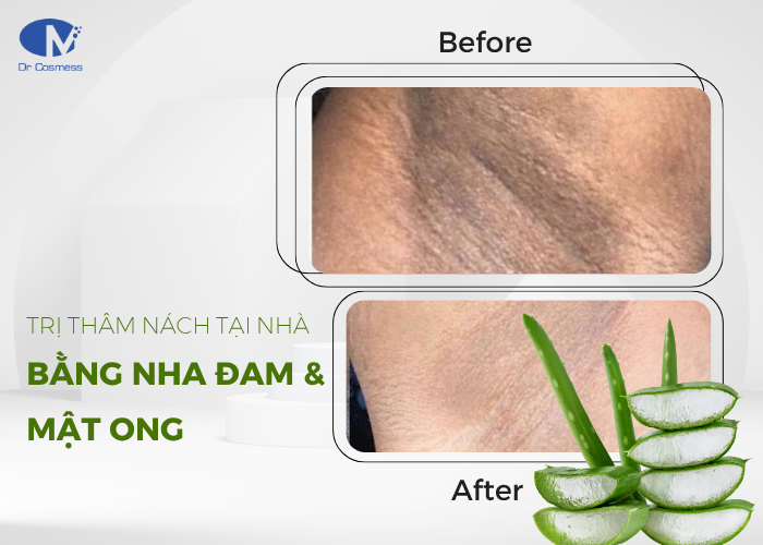 Hỗn hợp nha đam và mật ong trị thâm nách hiệu quả