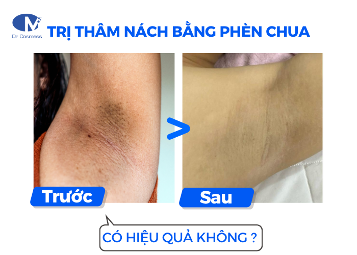 Trị thâm nách bằng phèn chua, khử mùi hiệu quả