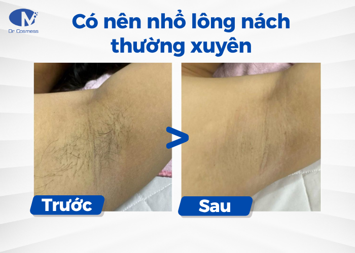 Có nên nhổ lông nách thường xuyên?