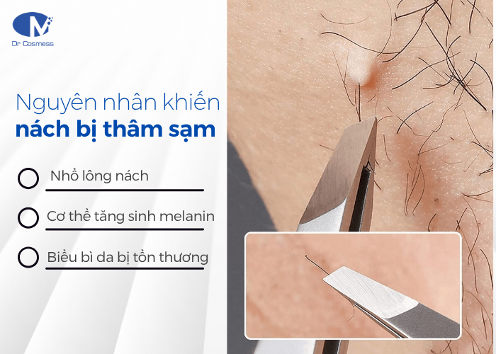 Nhổ lông nách có phải là nguyên nhân khiến nách bị thâm sạm
