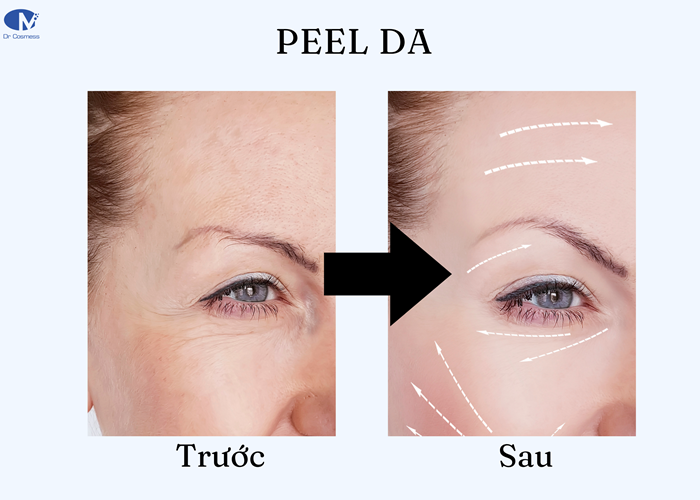Trước và sau khi peel da sẽ như thế nào?