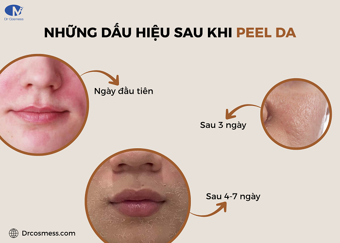 Những dấu hiệu thường gặp sau khi peel da