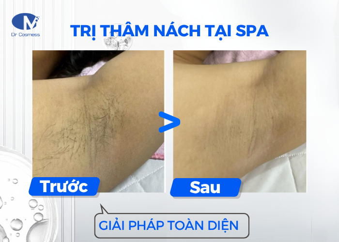 Trị thâm nách tại spa mang đến giải pháp toàn diện