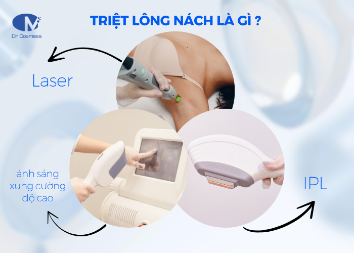 Triệt lông nách là phương pháp loại bỏ lông vùng da dưới cánh tay bằng công nghệ hiện đại