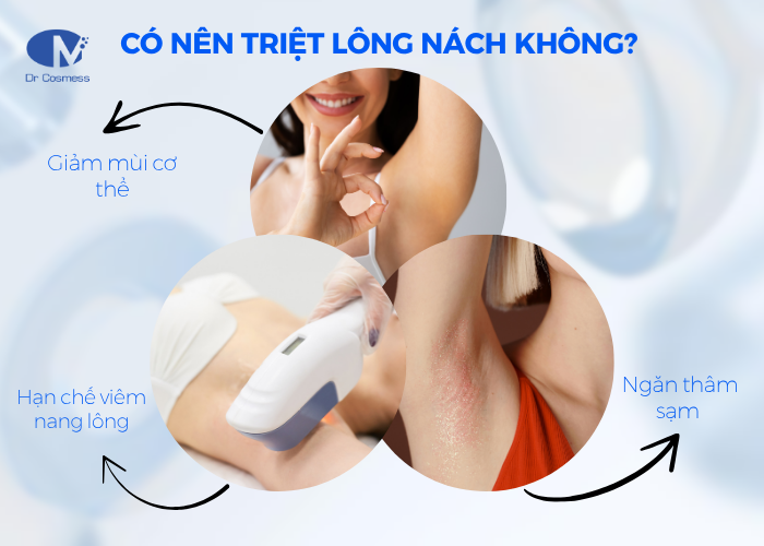 Có nên triệt lông nách bằng laser hoặc IPL không?