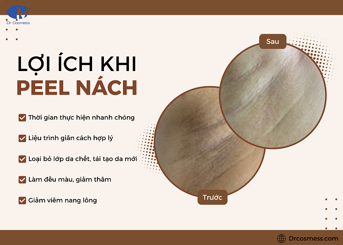 Những lợi ích mà phương pháp peel nách mang lại