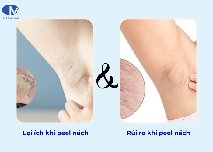 Lợi ích và rủi ro khi peel nách là gì?