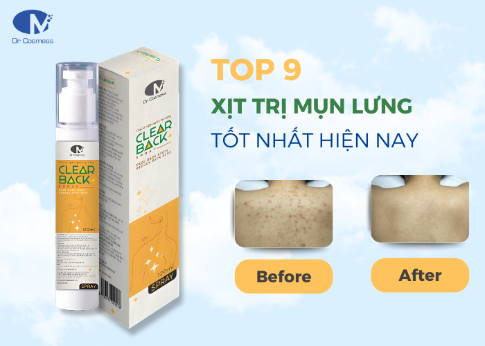 Top 9 Xịt trị mụn lưng hiệu quả hiện nay